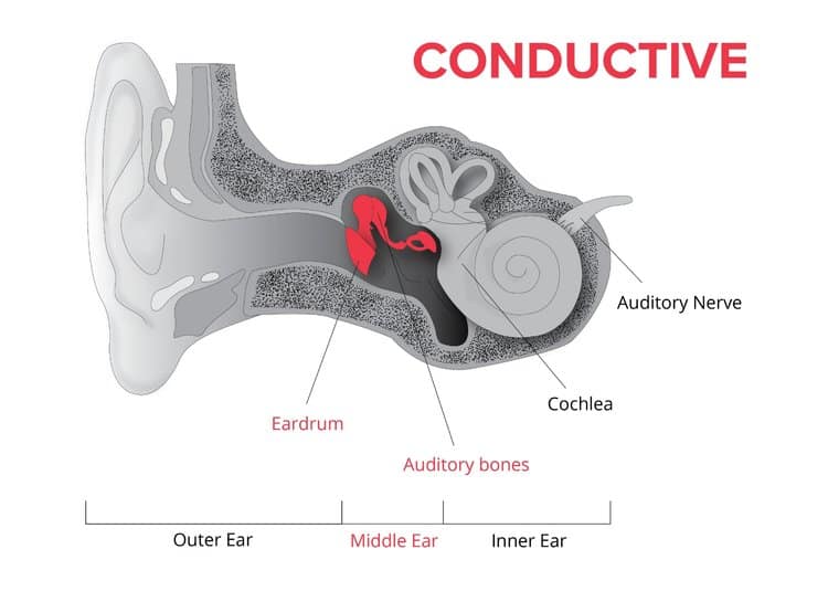 Types Of Hearing Loss Degrees Of Hearing Loss Speech Hearing