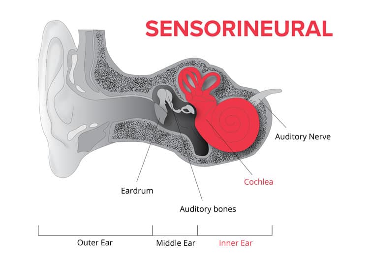 Sensorineural Hearing Loss Causes